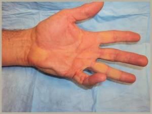 Dupuytrens Contracture Pre Treatment