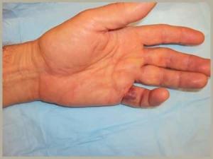 Dupuytrens Contracture Post Treatment