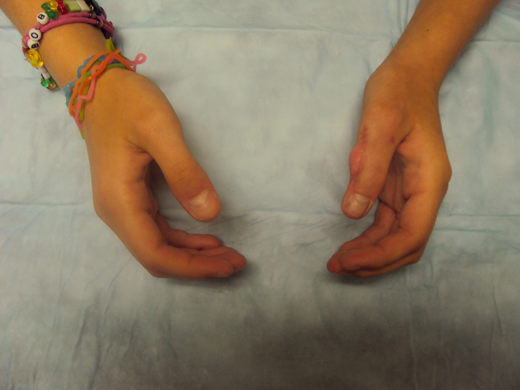 Thumb Duplication Hand and Wrist Surgery Cypress, Tomball, Katy