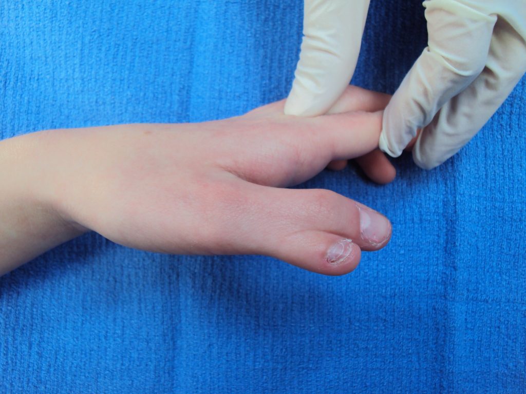 Thumb Duplication Hand and Wrist Surgery Cypress, Tomball, Katy